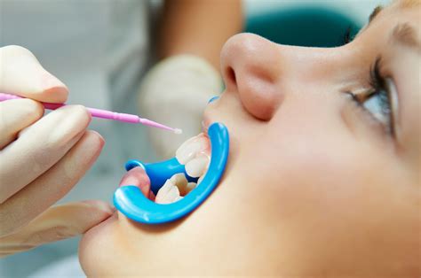 Dental Sealants and Fluoride Treatments – Fairfax, VA - Fairfax Family Dental Care