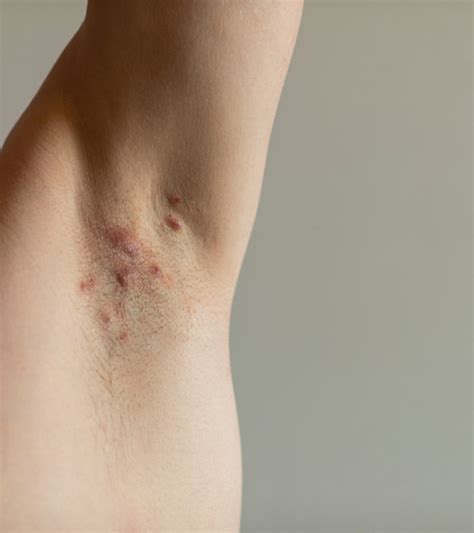 Hidradenitis Suppurativa: Causes, Symptoms, And Treatment