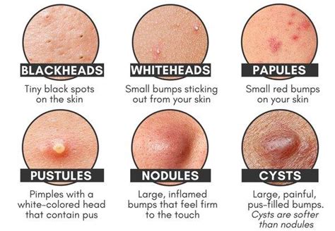 How To Pop A Pimple Correctly | From A Licensed Esthetician - Blog | taratheestie