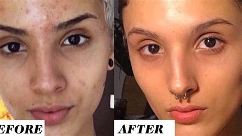 This Woman's Before-and-After Retinol Results Are Going Viral on Reddit | Marie Claire