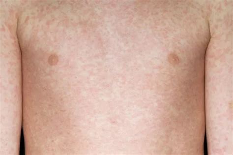 Seven measles symptoms you should know for potentially deadly disease ...