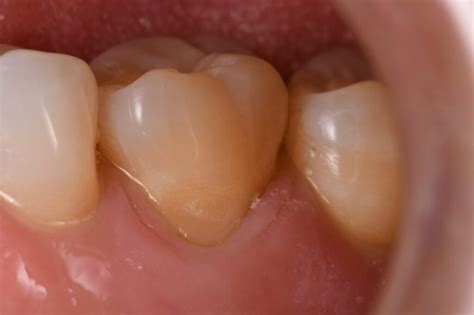 Cervical abrasion lesion on a root restored with composite