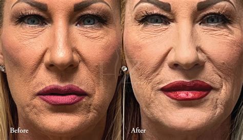 Upper Lip Lift Before & After — HZ Plastic Surgery