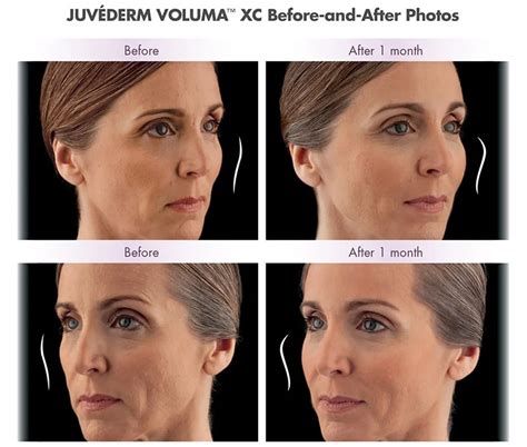 Juvederm Cheeks Before And After Photos