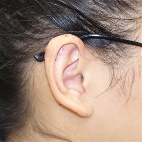 Earlobe Keloid Removal