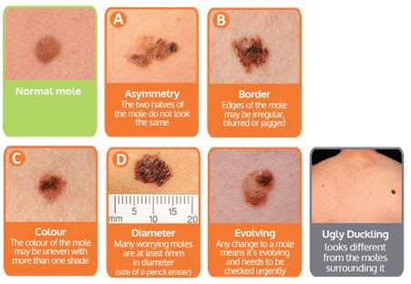 Malignant Melanoma Treatment - Dorset, Bournemouth, Christchurch