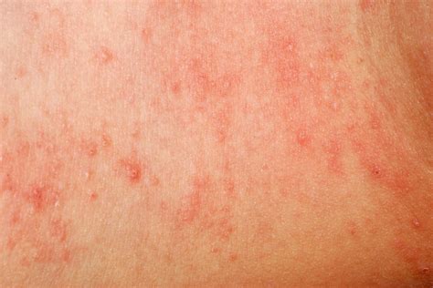 Pictures Of Dermatitis Rash