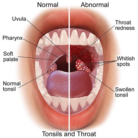 Difference Between Tonsillitis and Glandular Fever | Compare the ...