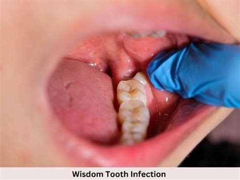 Understanding Wisdom Tooth Infections | Sleep Dentistry Brisbane