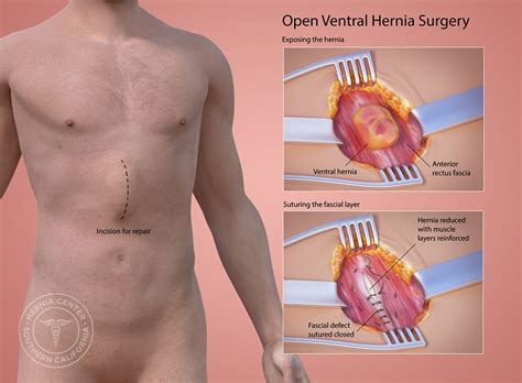 Ventral Hernia Repair Pasadena Orange County CA