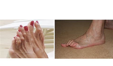 Claw Toes | Country Foot Care