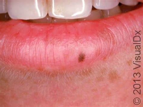 Melanoma On Lip Pictures In English - Infoupdate.org