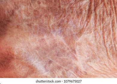 Skin Atrophy Royalty-Free Images, Stock Photos & Pictures | Shutterstock