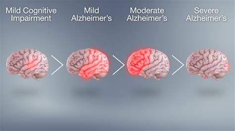 Progression of Alzheimer’s disease through different stages