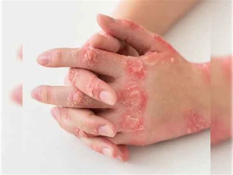 Eczema Scars: What All You Should Know? - TV Health