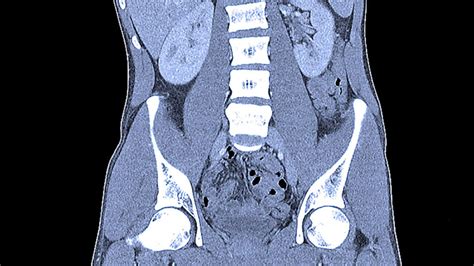 Abdominal CT scans: Definition, uses, picture, and more