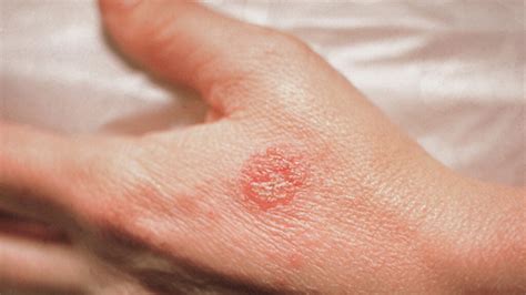 Circle rashes on the skin but not ringworm: Other causes