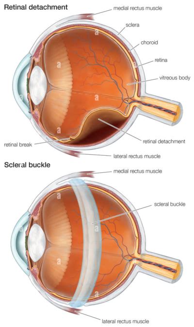 Scleral Buckle Surgery for Retinal Detachment at Venice Retina