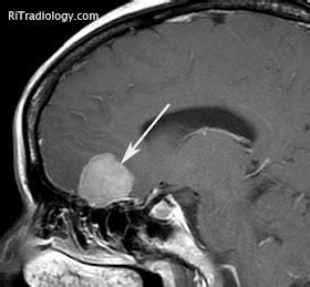 RiT radiology: Olfactory Groove Meningioma