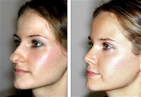 The Most Popular Cosmetic Surgeries | Nose plastic surgery, Rhinoplasty ...