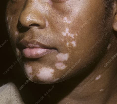 Vitiligo skin patches - Stock Image - C046/5339 - Science Photo Library