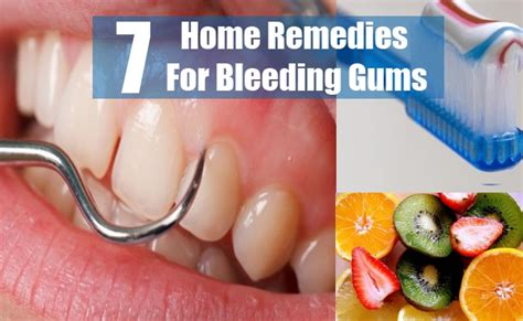 7 Bleeding Gums Home Remedies, Natural Treatments And Cures ...