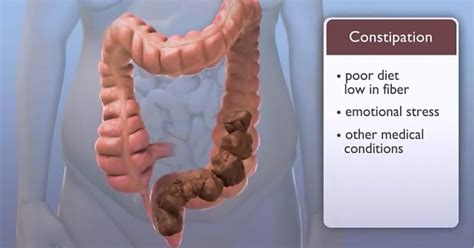 My Family Medicine Practice: Chronic Constipation - Causes , Signs&Symptoms And Management