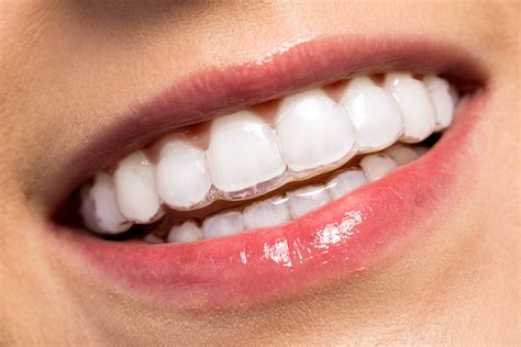Straighten Teeth with Invisalign Clear Braces - Regent Dental Cambridge