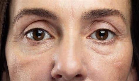 Sunken Eyes – Causes and Solutions Blog - Dr Karan Chopra PS