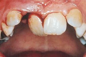 Lateral Luxation of tooth - prognosis, management and treatment | News | Dentagama