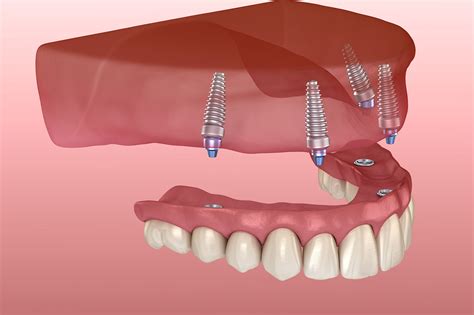 Implant Supported Dentures - Sparacino Periodontics