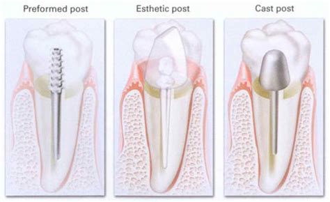 Learn the Post & Crown Procedure — Emergency Dentist Brooklyn NY