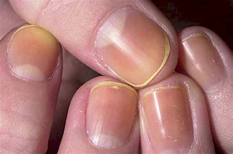 15 Health WARNINGS Your Fingernails May Be Sending