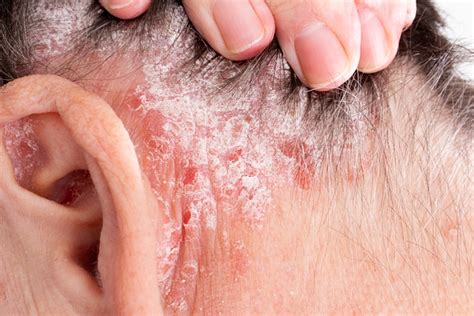 Dr Benjamin Loh’s guide to itchy ears and ear eczema in Singapore (2022) - Dr Ben Medical - Men ...