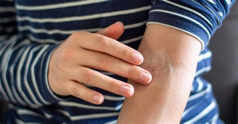 What Causes Dry White Patches on Skin? - Scripps Health