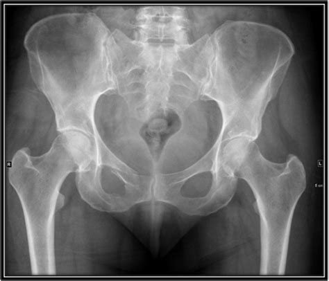 SWSLHD - Medical Imaging - Pelvis X-ray