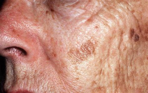 Dark Age Spots On Face