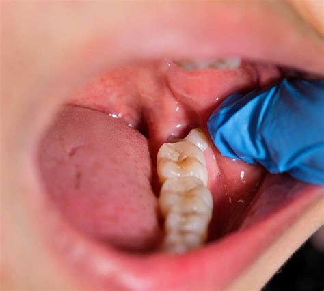 Wisdom Teeth Removal (Extraction) - Moggill Dental