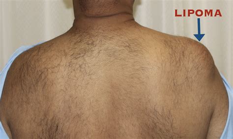 Lipoma - Dr Aashish Sasidharan - Plastic & Reconstructive Surgeon