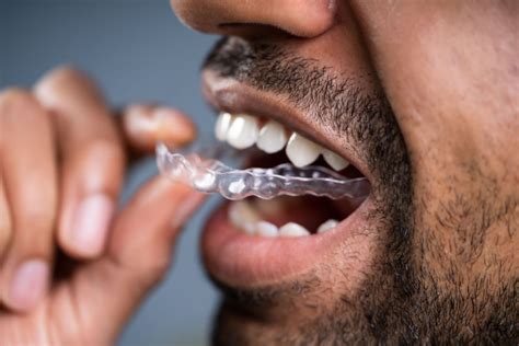 Do Clear Aligners Like Invisalign Lead to Cavities? | Shining Smiles Family Dentistry