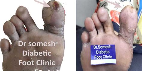 Diabetic Foot Gangrene stages Great Toe Tip - Podiatry Doctor