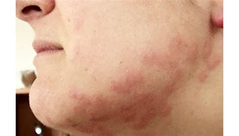 Bed Bug Bites On Face And Neck