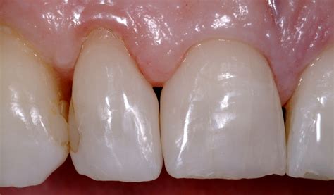 A Modern Day And Predictable Approach To Gingival Embrasures - Optident