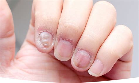 Understanding Fungal Nail Infections: Symptoms, Diagnosis, and ...