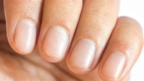 Nail Pitting: What Causes It & How You Can Treat It