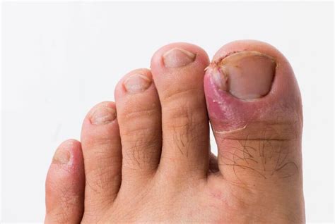 All About Ingrown Toenails - An Tâm