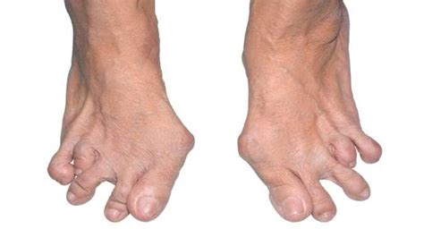 Rheumatoid Arthritis Feet Early Signs