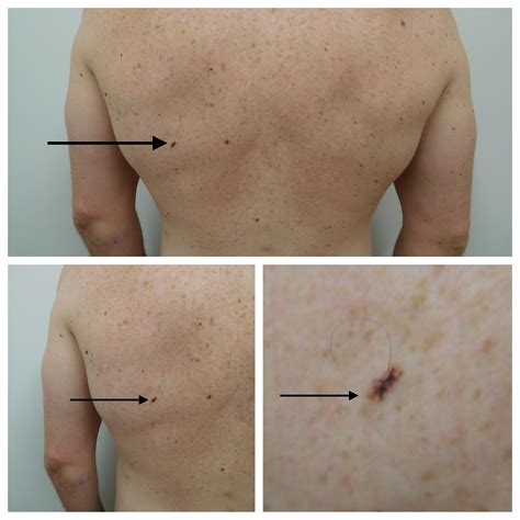 Pictures Of Skin Cancer On Upper Back - CancerWalls