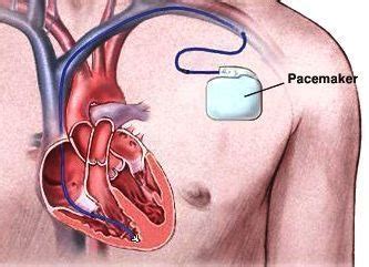 Medical Emergencies: Chapter 12 Cardiac Pacemaker and Implantable Cardioverted Defibrillator ...