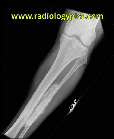 Solution to Unknown Case #35 – Calcific Myonecrosis | RADIOLOGYPICS.COM